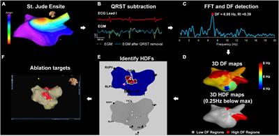 Simultaneous Whole-Chamber Non-contact Mapping of Highest Dominant Frequency Sites During Persistent Atrial Fibrillation: A Prospective Ablation Study